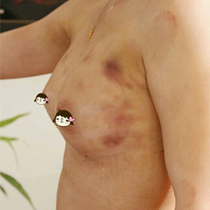 深圳美源做的自體脂肪隆胸，大家來看看果如何?