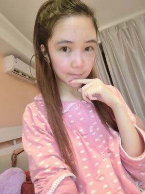 自體脂肪面部填充恢復時間挺短的，很快就自然了