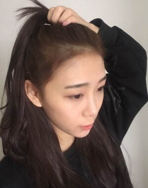 面部埋x后的恢復過程 快來看看我的果吧