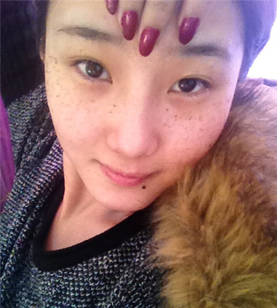 激光去雀斑+華爾茲冰點脫全身毛術(shù)后恢復(fù)過程照片分享~~