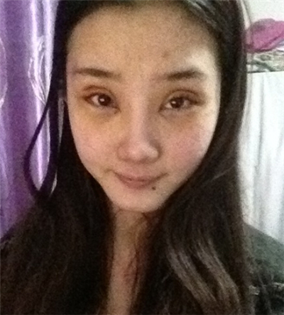 激光去雀斑+華爾茲冰點脫全身毛術(shù)后恢復(fù)過程照片分享~~