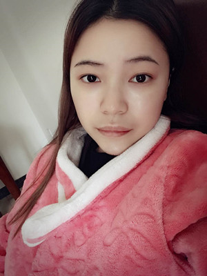 去年12月做的自體脂肪填充蘋果肌，大家來看看果怎么樣?