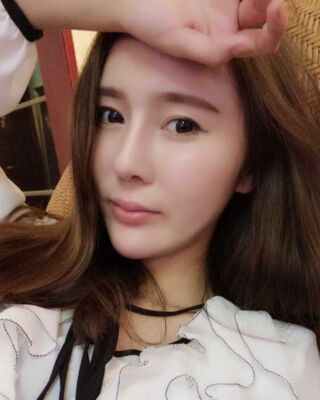 隆鼻整形+自體脂肪面部填充手術(shù)對(duì)比照片