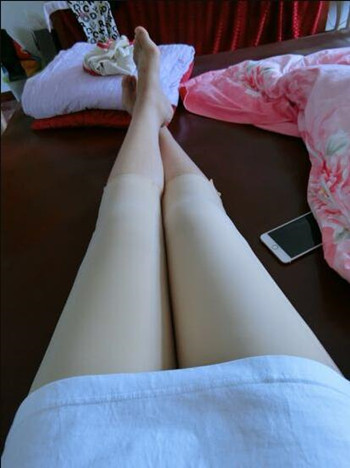 我的大腿吸脂真實(shí)果恢復(fù)對(duì)比案例圖