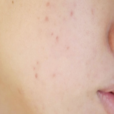 激光祛痘兩個(gè)月了，分享術(shù)后恢復(fù)過程照片~