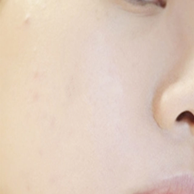 激光祛痘兩個(gè)月了，分享術(shù)后恢復(fù)過程照片~