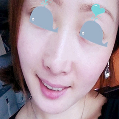 激光祛痘兩個(gè)月了，分享術(shù)后恢復(fù)過程照片~