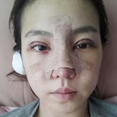 隆鼻整形+切開(kāi)雙眼皮三個(gè)月恢復(fù)照片分享，莆田維納斯做的~