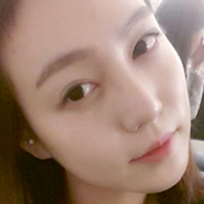 隆鼻整形+切開(kāi)雙眼皮三個(gè)月恢復(fù)照片分享，莆田維納斯做的~