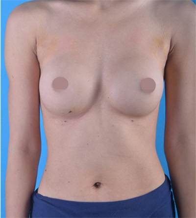 250cc假體隆胸手術(shù)恢復(fù)過程和前后對(duì)比果圖片分享~