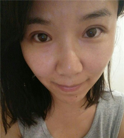 紅藍(lán)光祛痘手術(shù)恢復(fù)過(guò)程分享，還有前后對(duì)比果圖片哦~