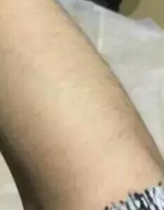 激光脫毛之前的照片