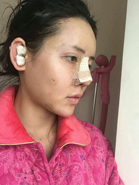 自體軟骨隆鼻+自體脂肪豐蘋(píng)果肌，成功逆襲成女神