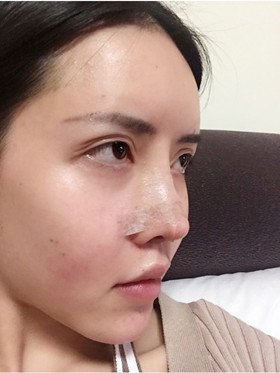 自體軟骨隆鼻+自體脂肪豐蘋(píng)果肌，成功逆襲成女神