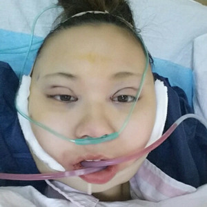 切開(kāi)雙眼皮+磨下頜角，記錄了手術(shù)前后的過(guò)程，給大家分享一下