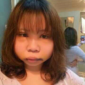 切開(kāi)雙眼皮+磨下頜角，記錄了手術(shù)前后的過(guò)程，給大家分享一下