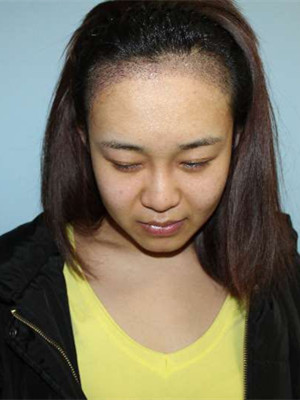 做了發(fā)際線種植手術(shù)，感覺還不錯(cuò)!