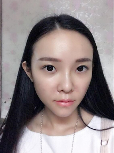 我的自體脂肪填充下巴+蘋果肌的恢復過程 自體脂肪真的是一個好東西