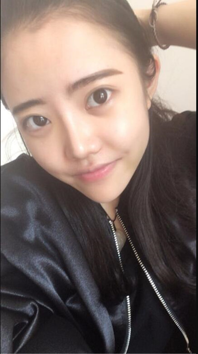 我的隆鼻整形恢復前后對果圖 一個字帥