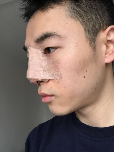 我的隆鼻整形案例恢復(fù)過程 大老爺們也有一個愛沒的心