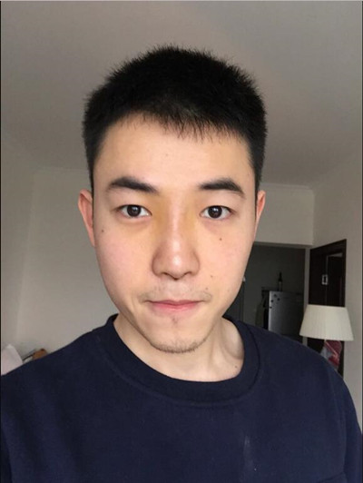 我的隆鼻整形案例恢復(fù)過程 大老爺們也有一個愛沒的心