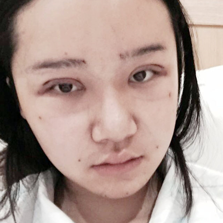 做切開雙眼皮三個月了，分享恢復(fù)過程和前后對比果照片~