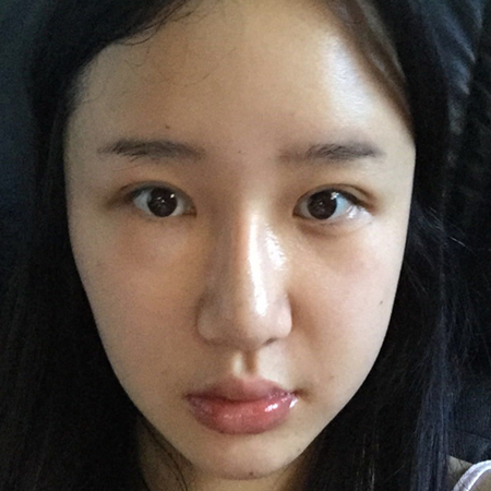 做切開雙眼皮三個月了，分享恢復(fù)過程和前后對比果照片~