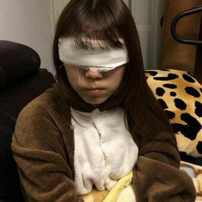 開內(nèi)眼角+切開割雙眼皮兩個(gè)月了，分享術(shù)后恢復(fù)過程照片~