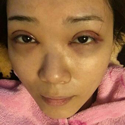 開內(nèi)眼角+切開割雙眼皮兩個(gè)月了，分享術(shù)后恢復(fù)過程照片~