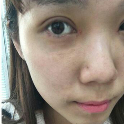 開內(nèi)眼角+切開割雙眼皮兩個(gè)月了，分享術(shù)后恢復(fù)過程照片~