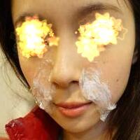 玻尿酸填充法令紋恢復(fù)過(guò)程分享，注射價(jià)格3000元