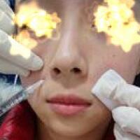 玻尿酸填充法令紋恢復(fù)過(guò)程分享，注射價(jià)格3000元