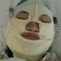 做了磨下頜角手術(shù)一年了，手術(shù)費用為16800元，已經(jīng)完全恢復(fù)