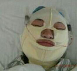 磨下頜角手術(shù)后第(一)天的照片