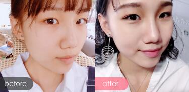 玻尿酸隆鼻前后對(duì)比圖