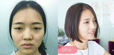 整形前后對比圖，左邊是微整形前