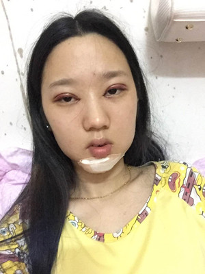 切開雙眼皮+假體隆下巴，我不再是典型的路人甲