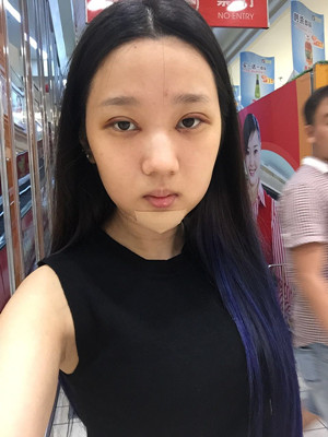 切開雙眼皮+假體隆下巴，我不再是典型的路人甲