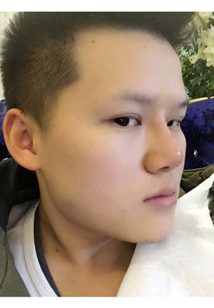 玻尿酸隆鼻+墊下巴親身經(jīng)歷~~果不錯哦