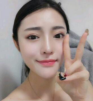 隆鼻整形1個月真實恢復(fù)期圖片