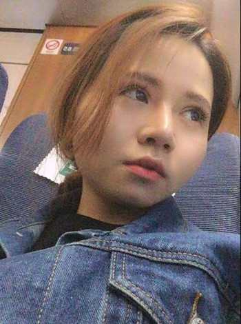 大鼻子就得做隆鼻整形手術(shù)改良 我的果就挺不錯的