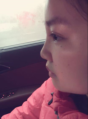我的隆鼻整形恢復(fù)時(shí)的那些事