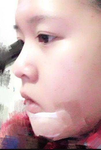 我的頰脂肪墊切除+假體墊下巴整形恢復(fù)果心情日記