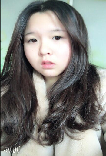 我的頰脂肪墊切除+假體墊下巴整形恢復(fù)果心情日記