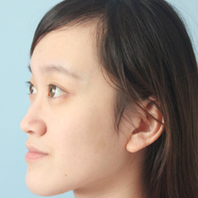 自體軟骨隆鼻手術(shù)前后對比果圖片分享，還有恢復(fù)過程哦~