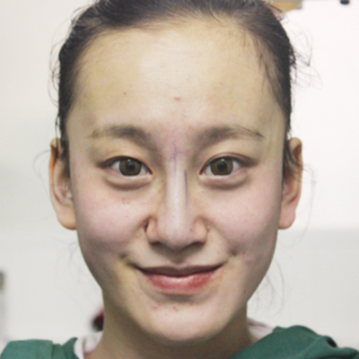 自體軟骨隆鼻手術(shù)前后對比果圖片分享，還有恢復(fù)過程哦~