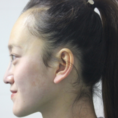 自體軟骨隆鼻手術(shù)前后對比果圖片分享，還有恢復(fù)過程哦~