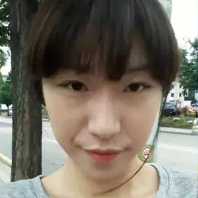 隆鼻整形+雙眼皮手術兩個月了，分享恢復前后對比果照片~