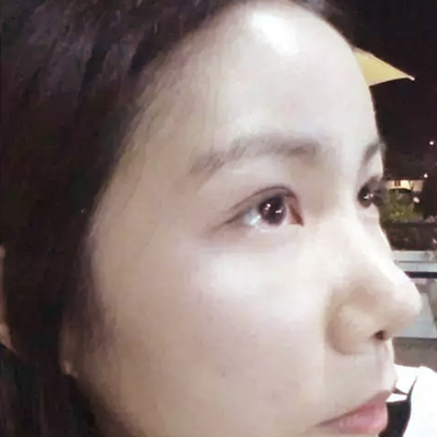 隆鼻整形+雙眼皮手術兩個月了，分享恢復前后對比果照片~