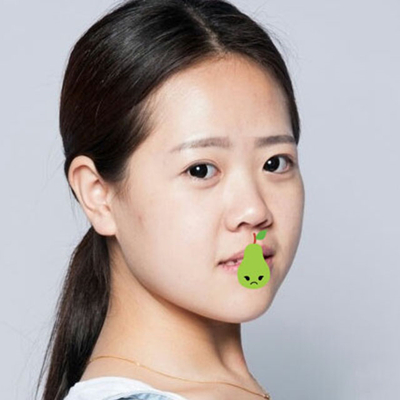 中加科洋做埋線雙眼皮一個(gè)月了，分享術(shù)后果照片~